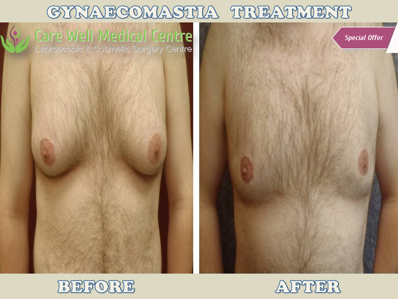 Gynaecomastia Treatment